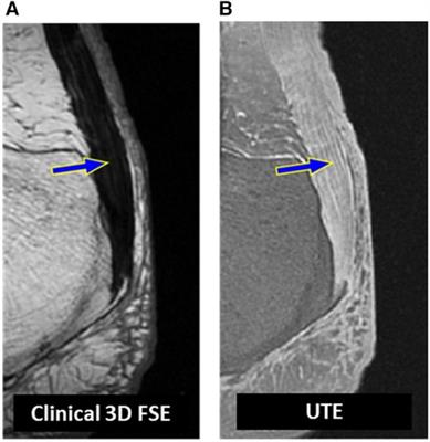 Tendon evaluation with ultrashort echo time (UTE) MRI: a systematic review